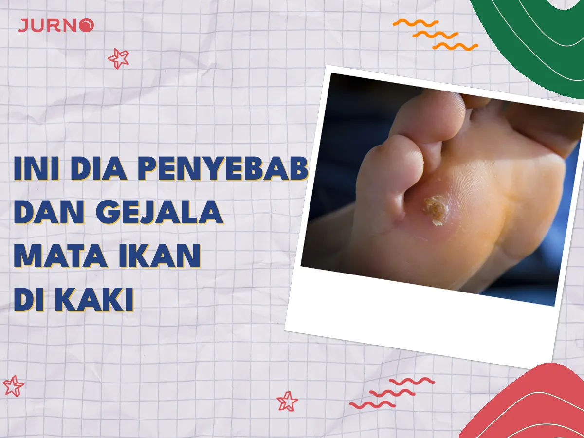 Penyebab Mata Ikan di Kaki yang Perlu Kamu Ketahui Penyebab Mata Ikan di Kaki yang Perlu Kamu Ketahui